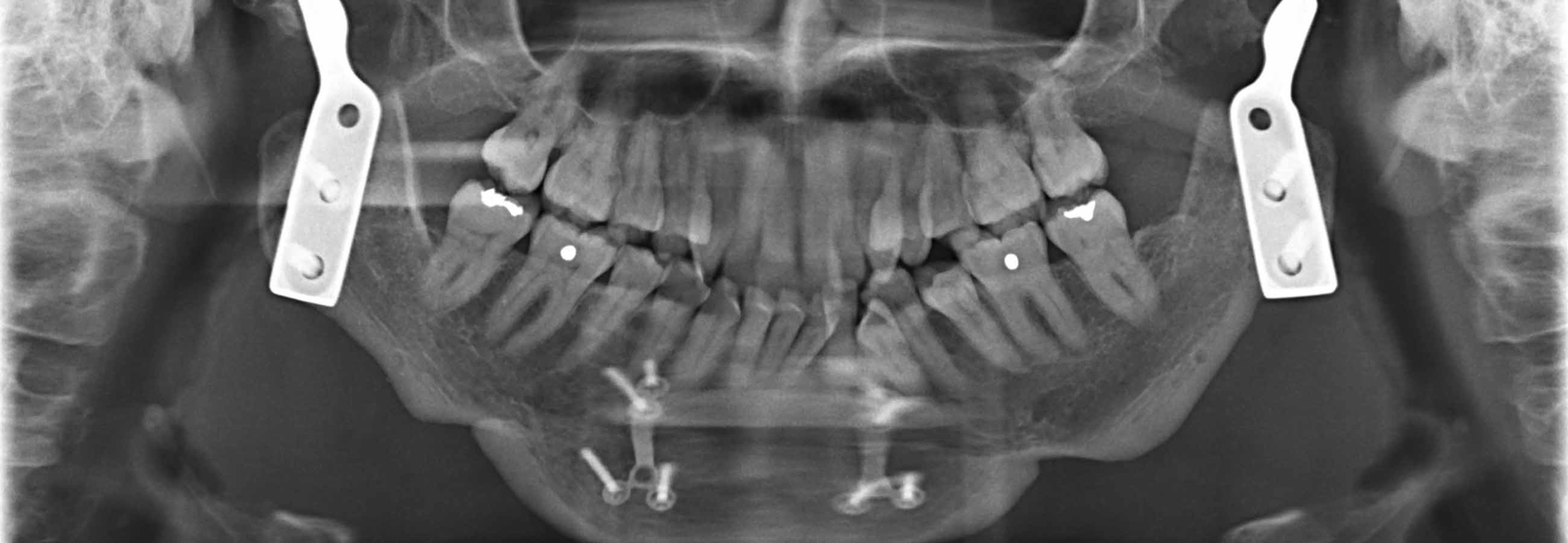 TMJ Implants The TMJ Association